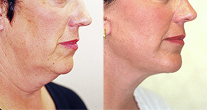 Before & After Photo Gallery