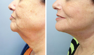 Patient before and after facelift by Dr. Hernandez